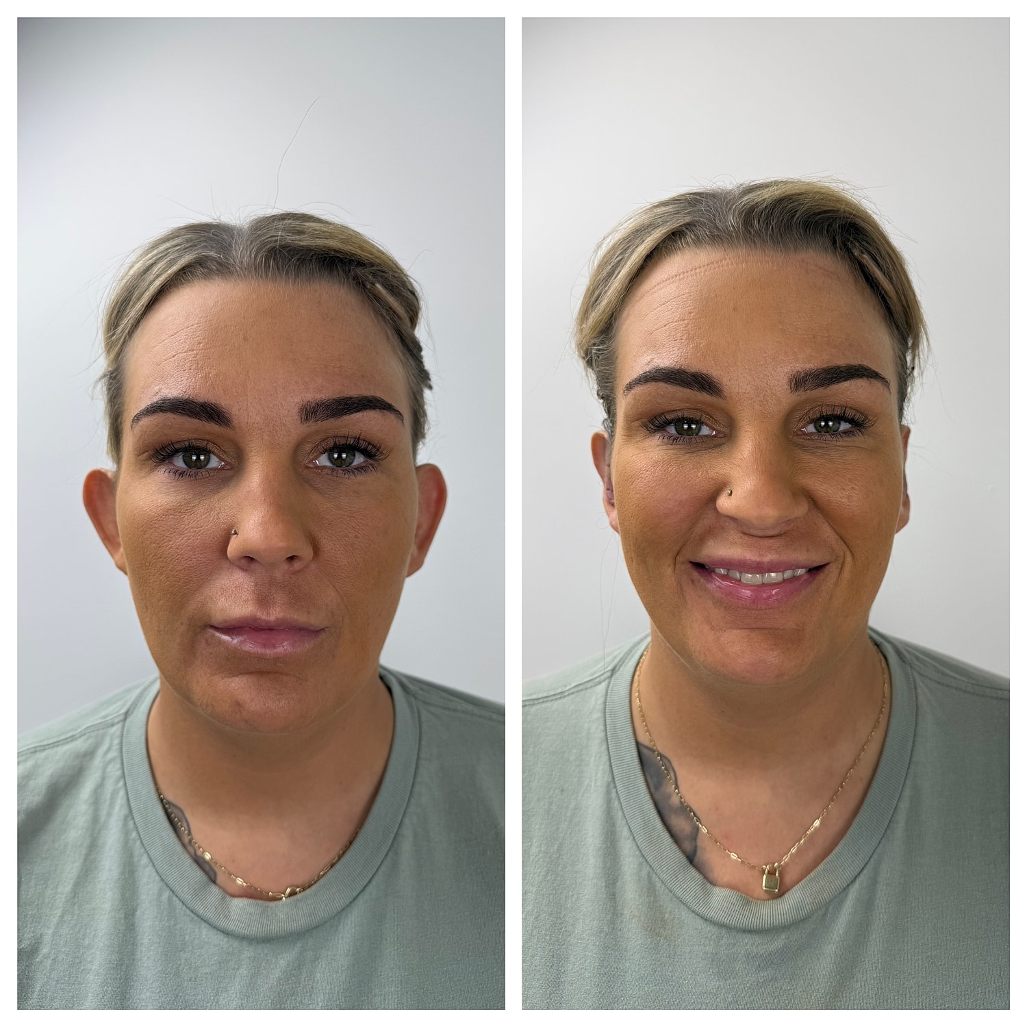 Ear Reshaping Before & After