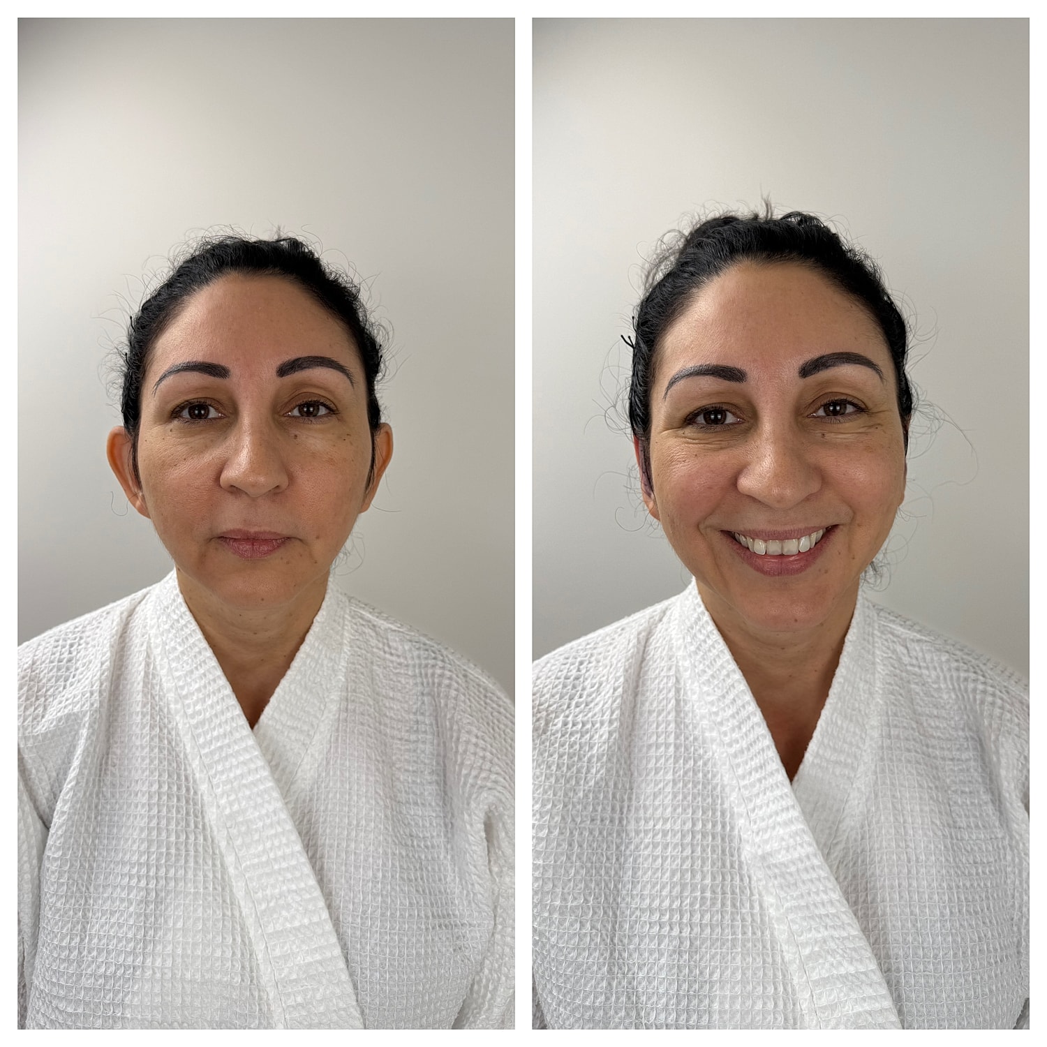 Ear Reshaping Before & After