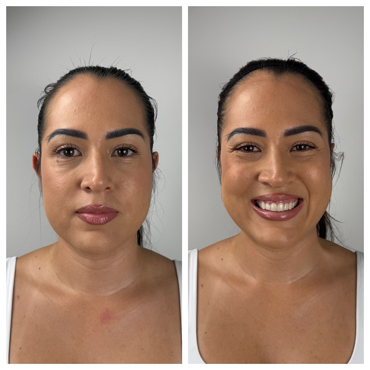 Ear Reshaping Before & After