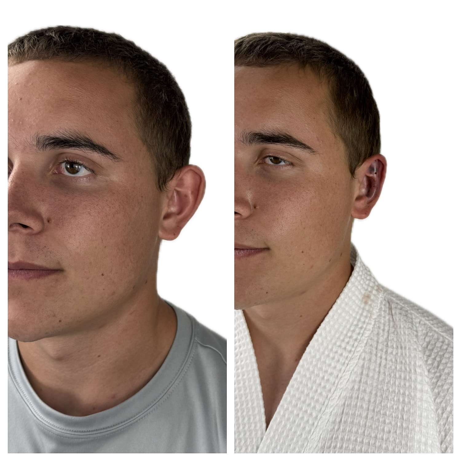 Ear Reshaping Before & After