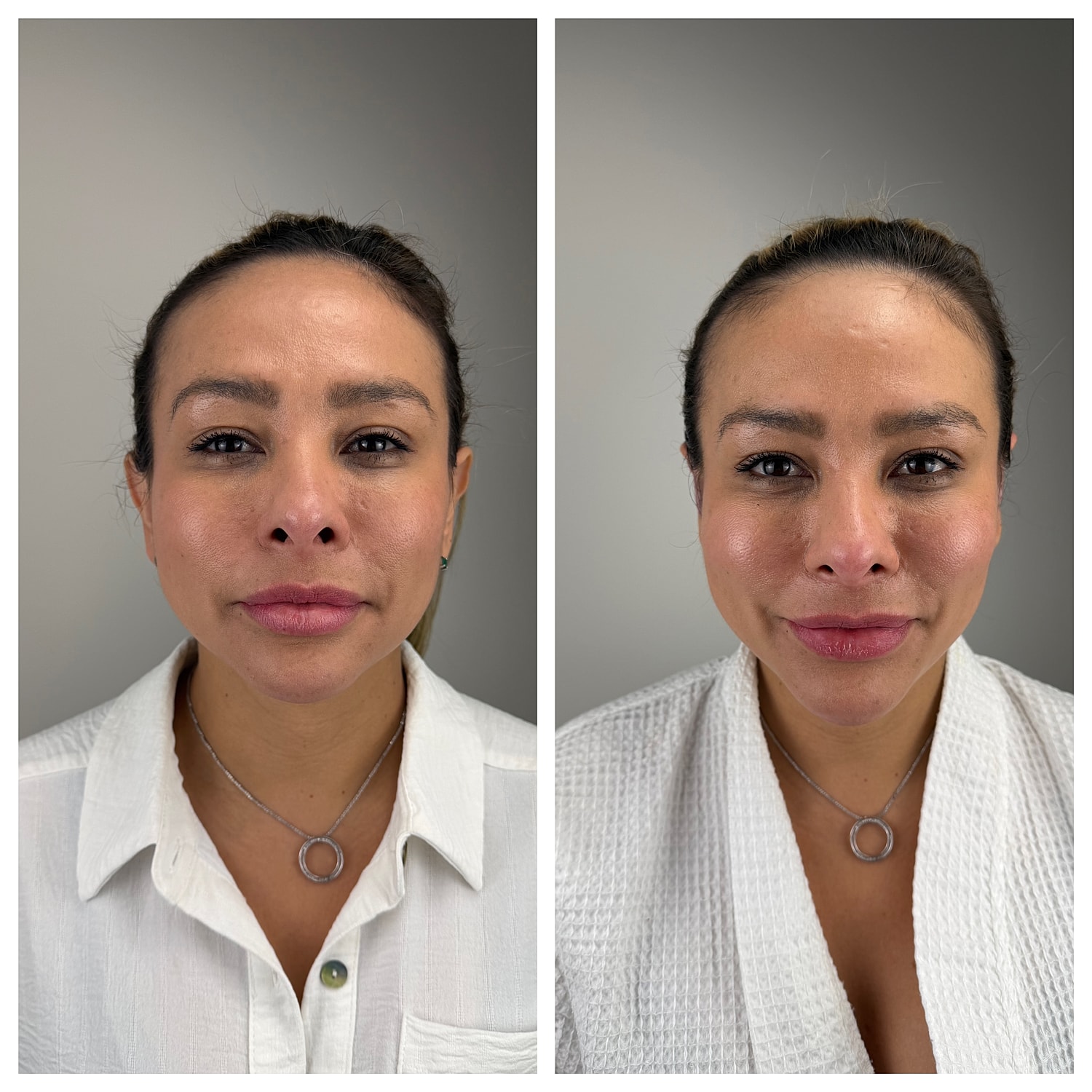 Ear Reshaping Before & After