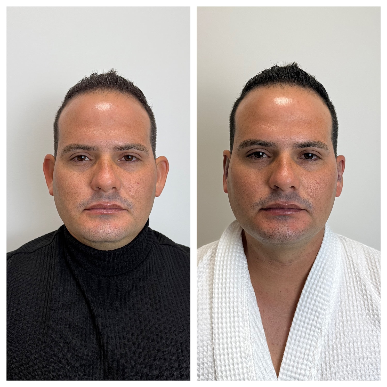 Ear Reshaping Before & After