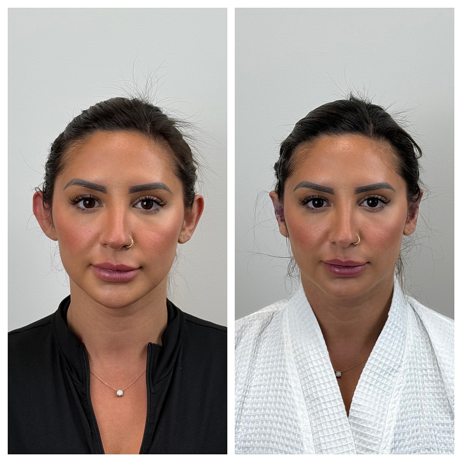 Ear Reshaping Before & After