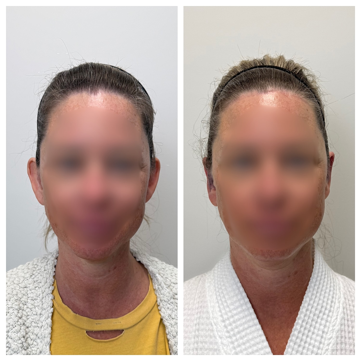 Ear Reshaping Before & After
