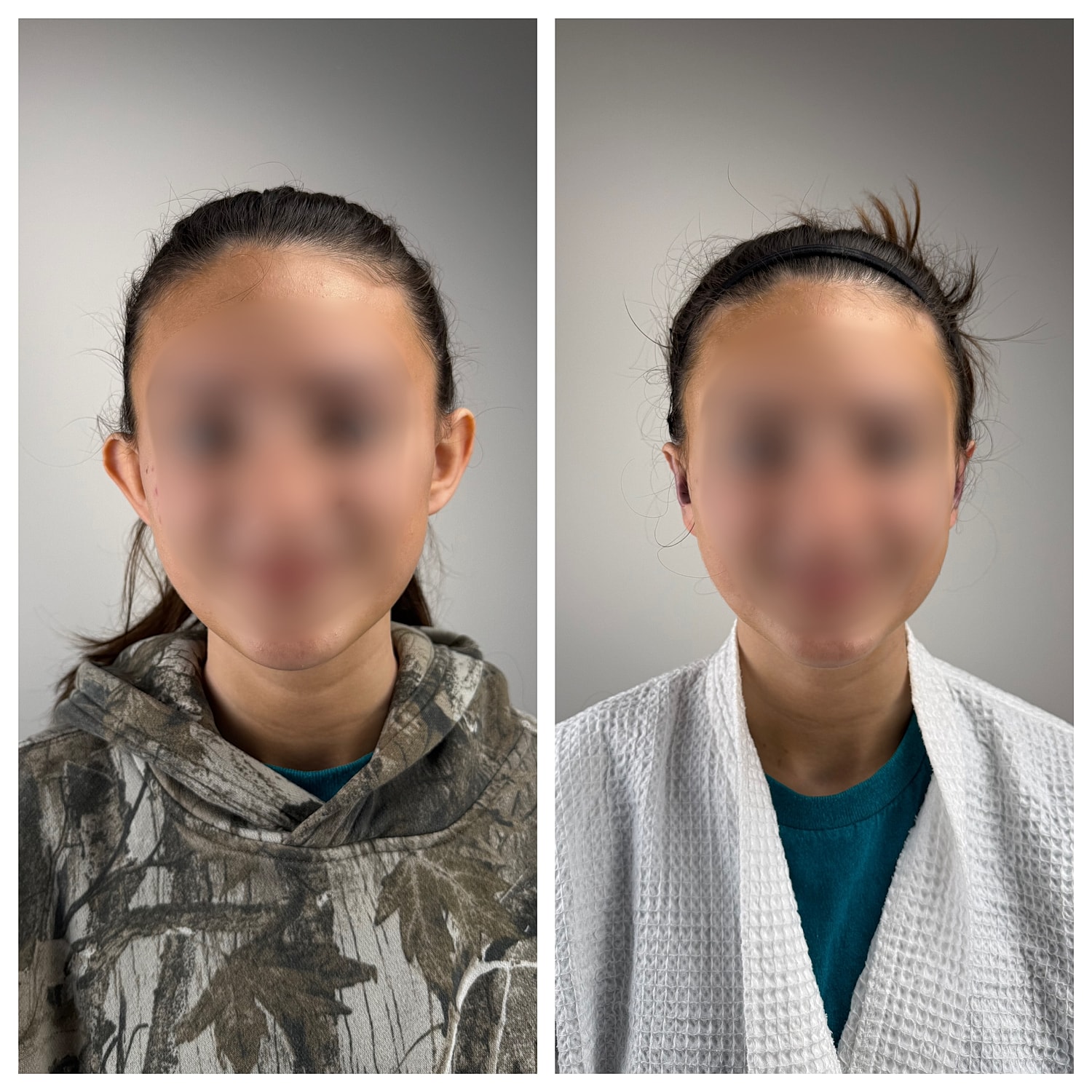 Ear Reshaping Before & After