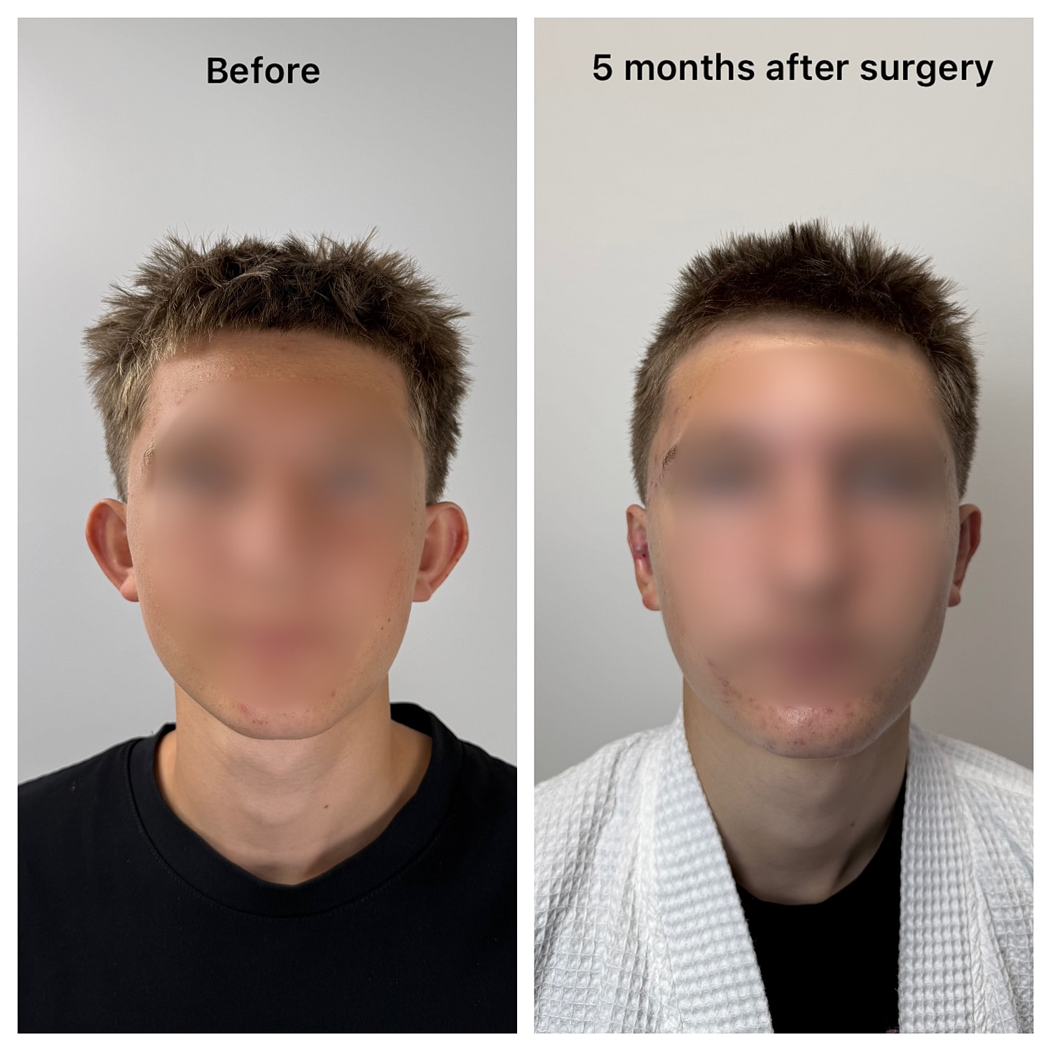 Ear Reshaping Before & After