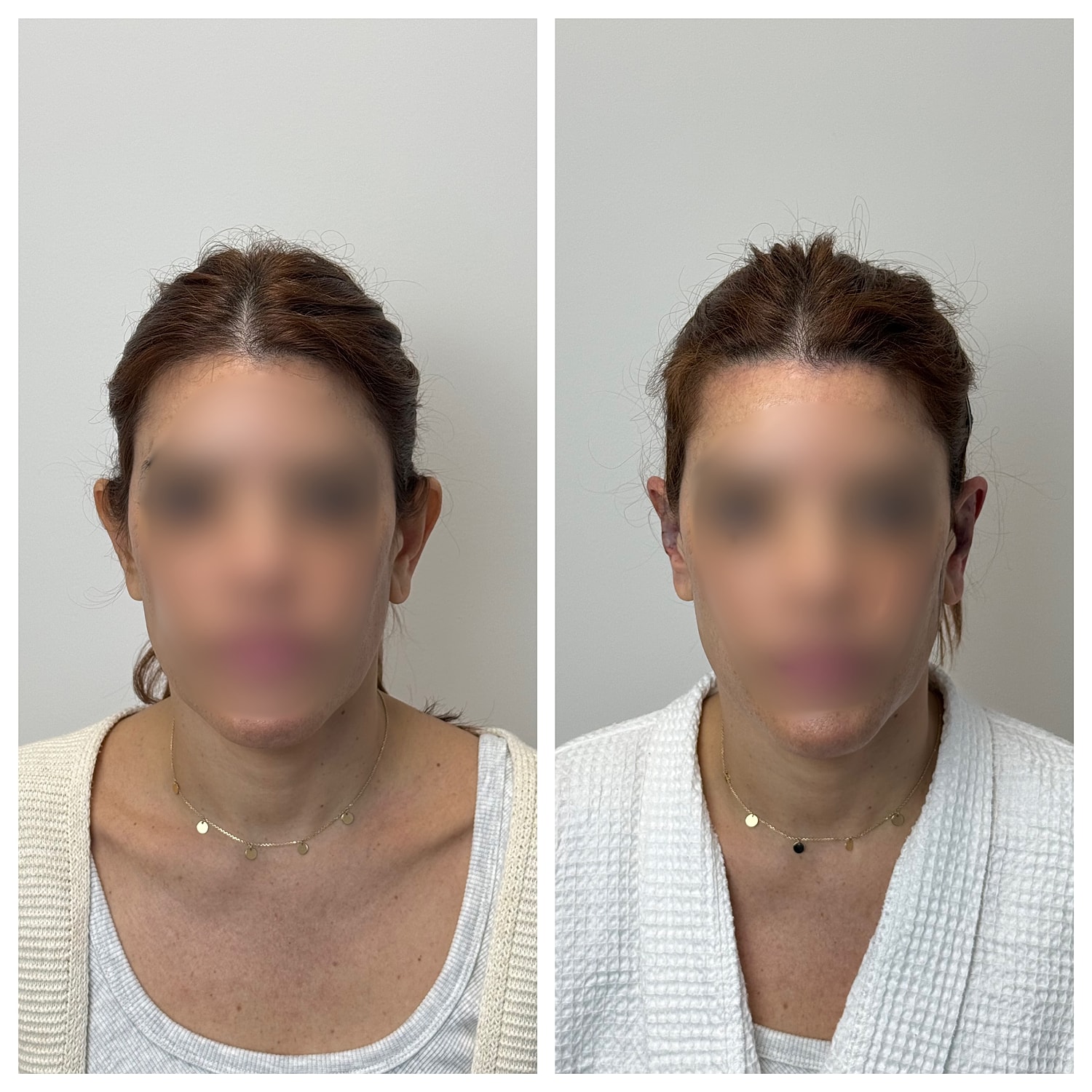 Ear Reshaping Before & After