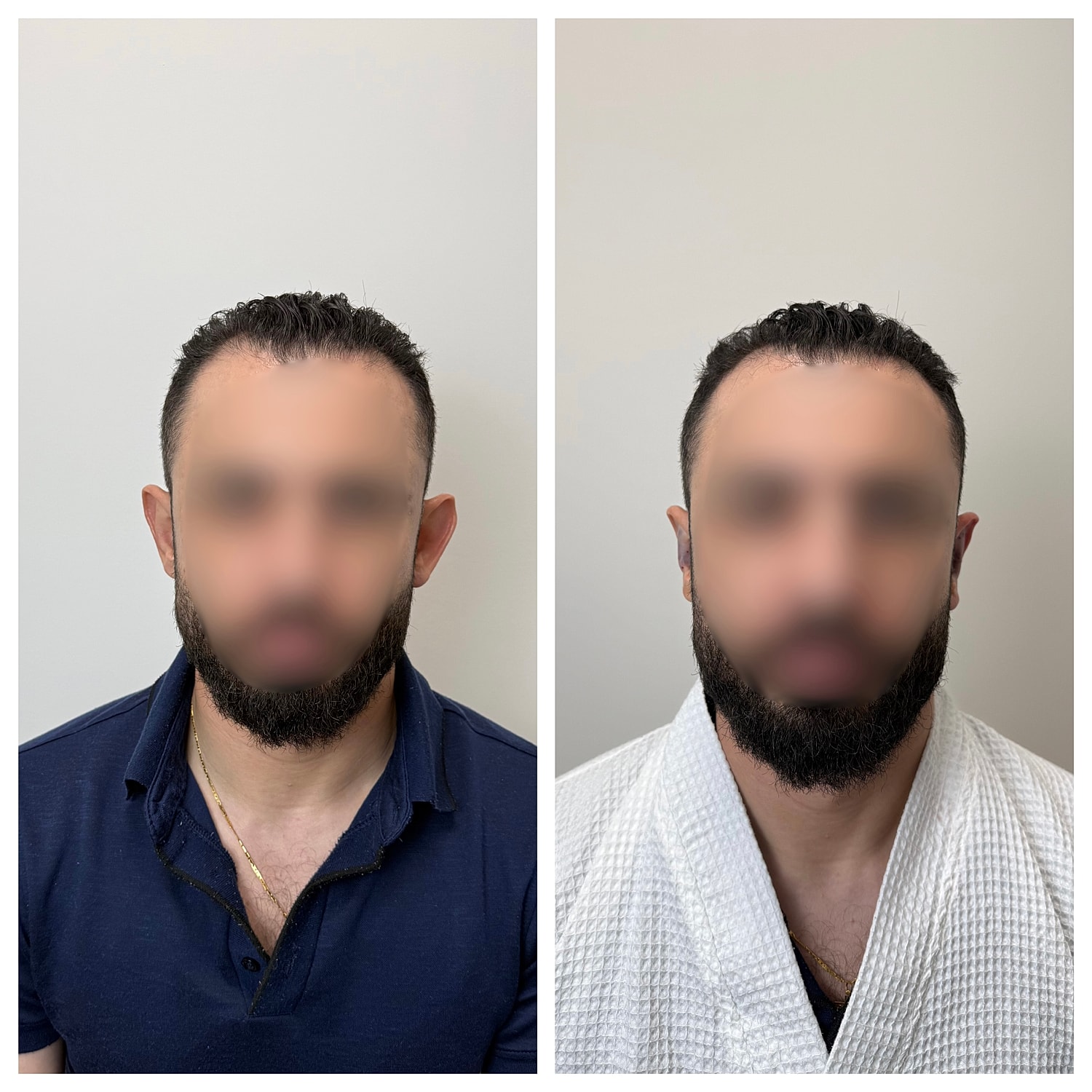 Ear Reshaping Before & After