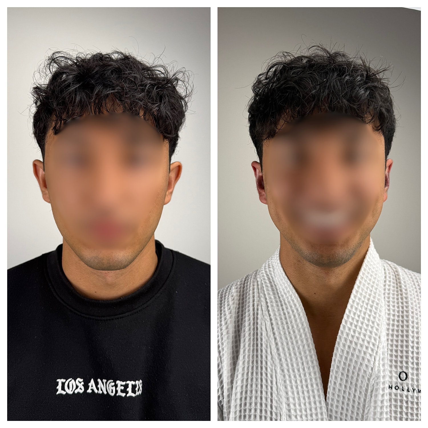 Ear Reshaping Before & After