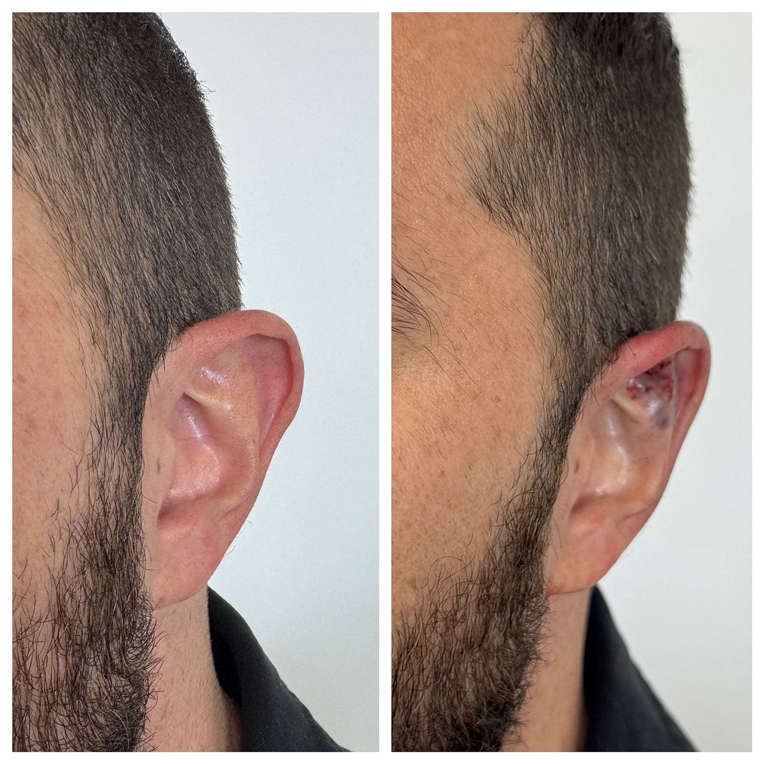 Ear Reshaping Before & After