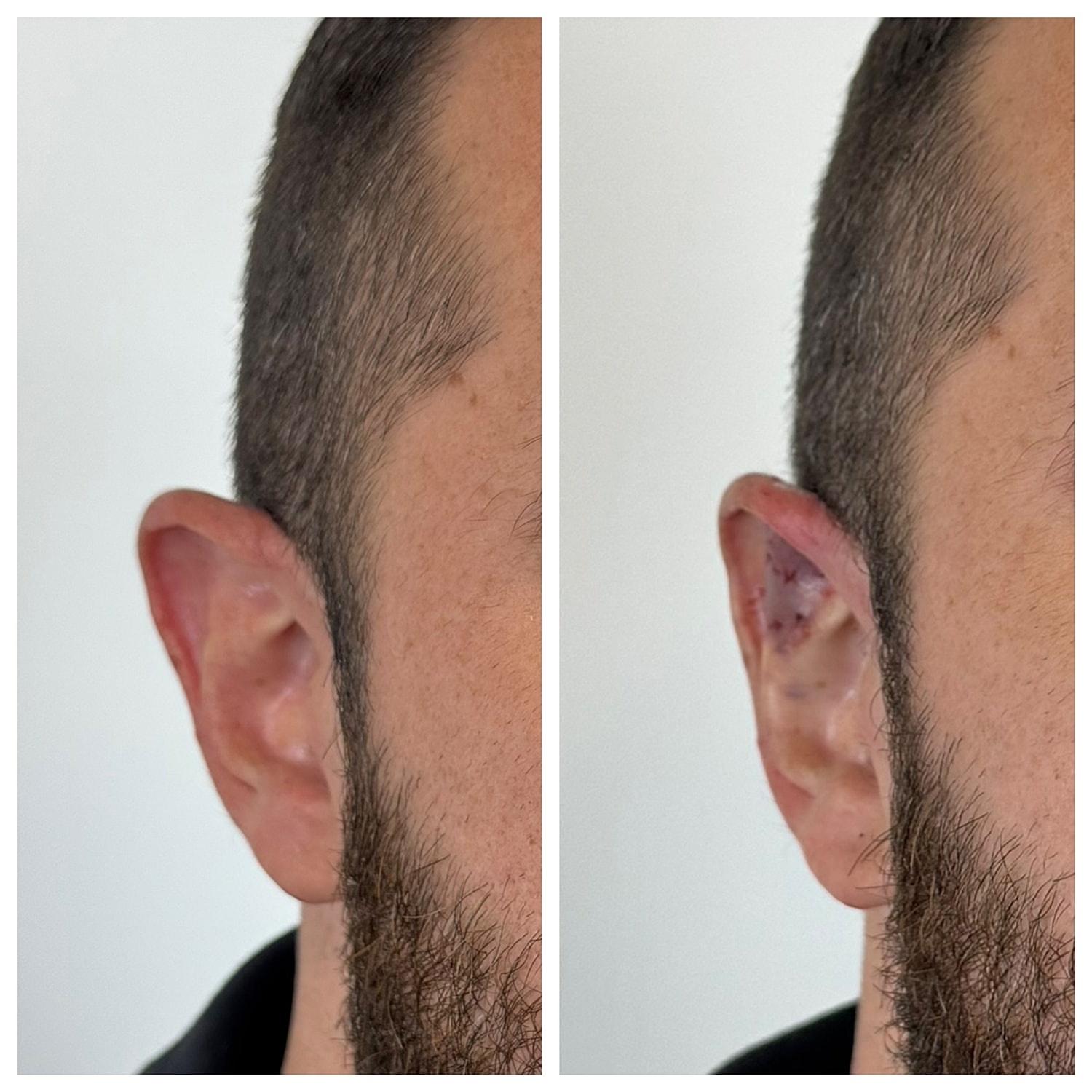 Ear Reshaping Before & After