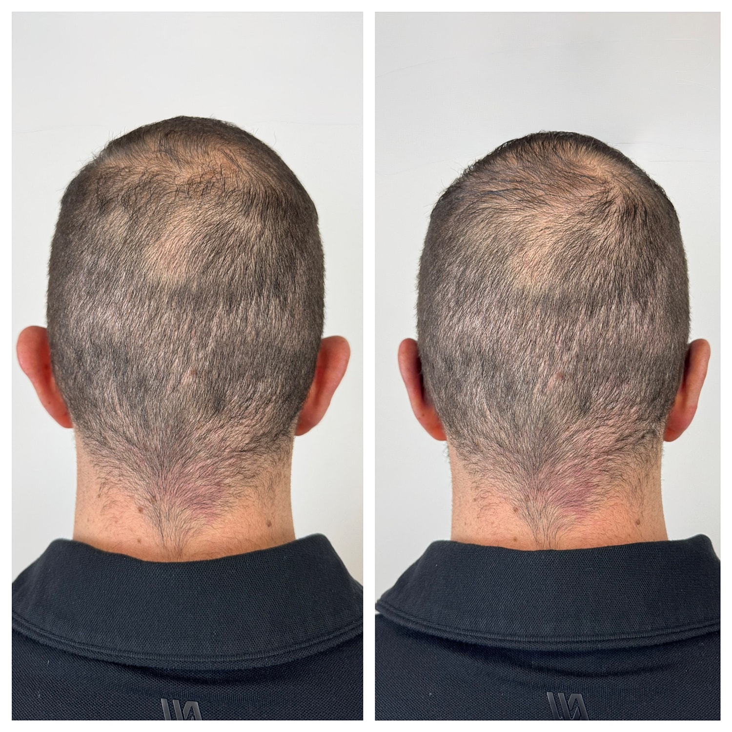 Ear Reshaping Before & After