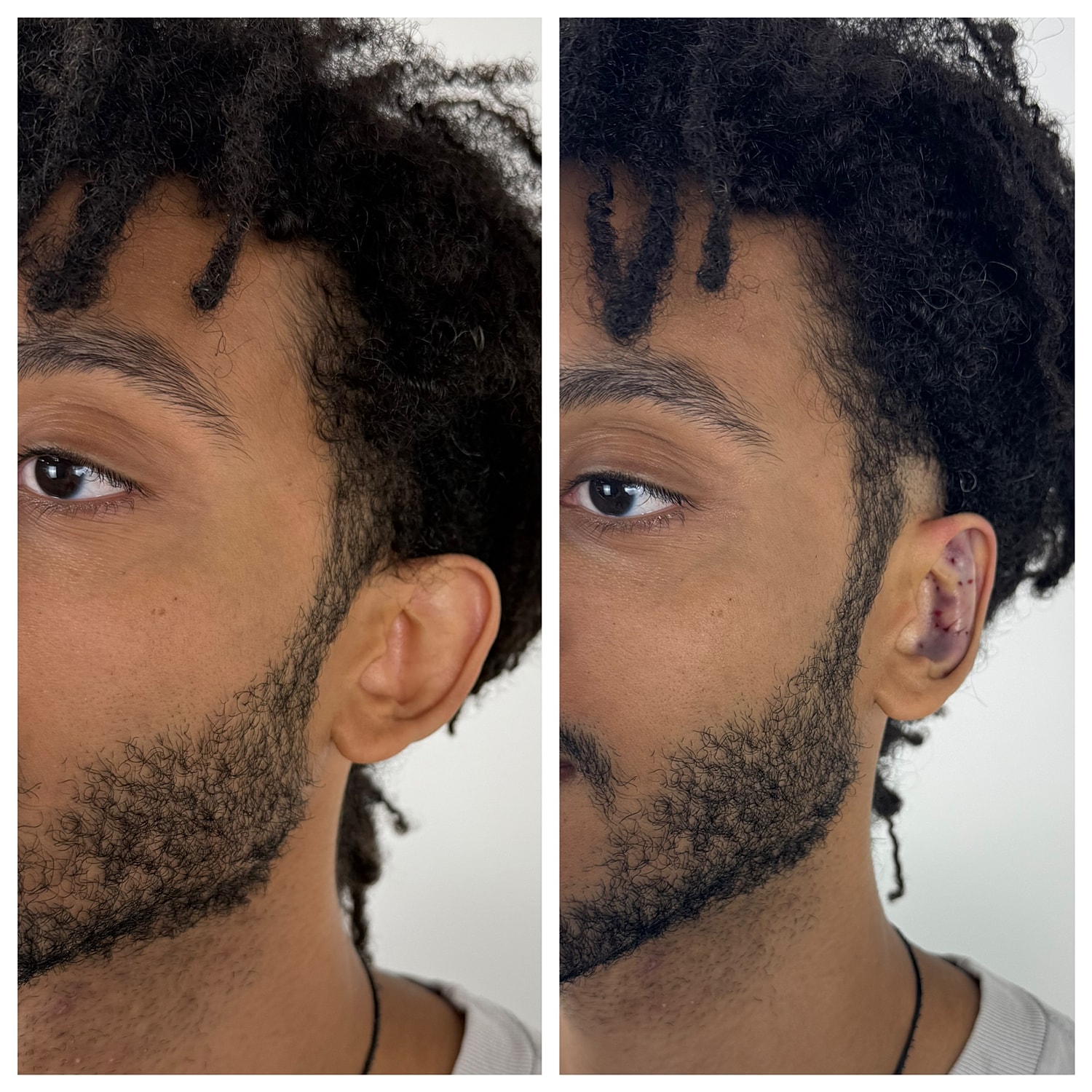 Ear Reshaping Before & After