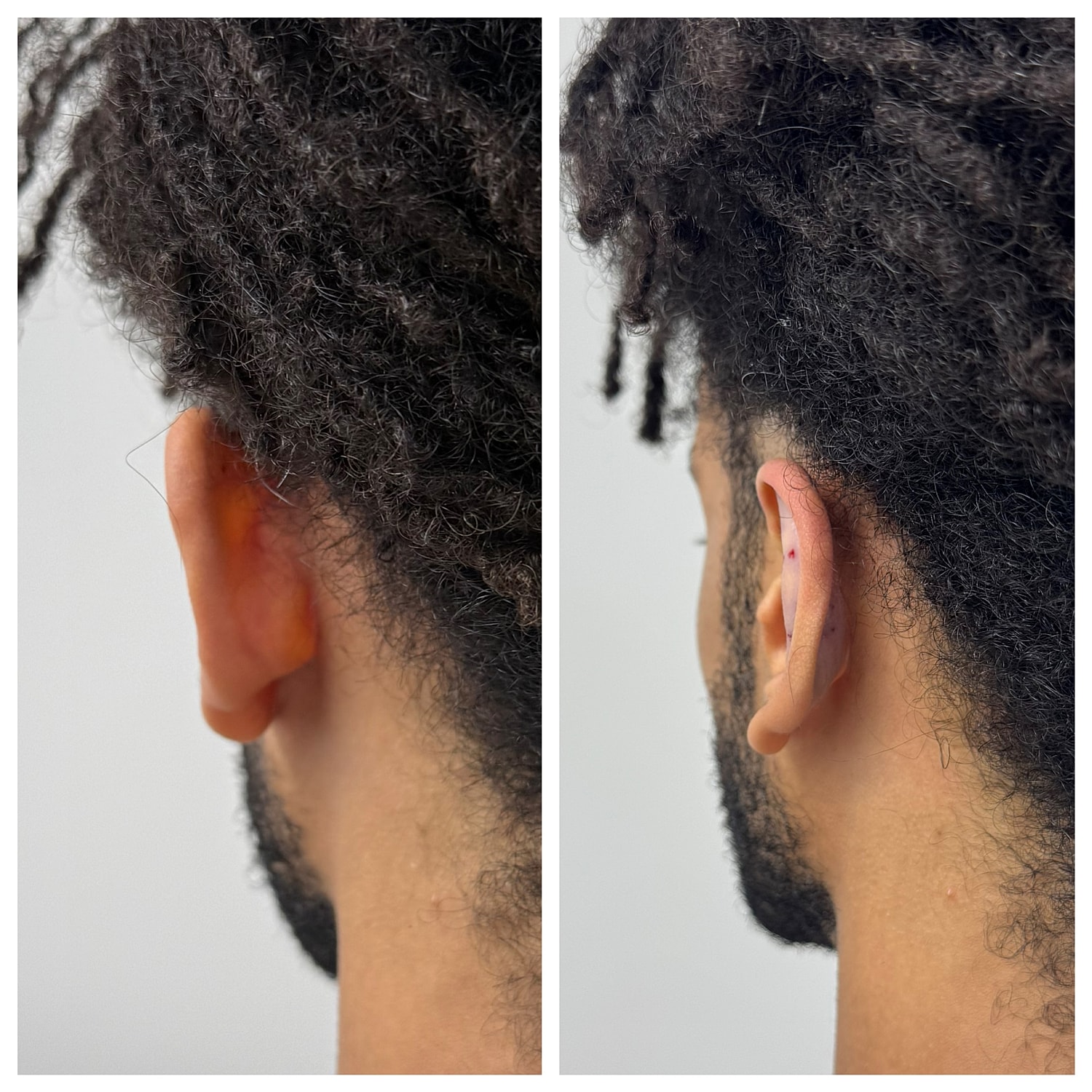Ear Reshaping Before & After