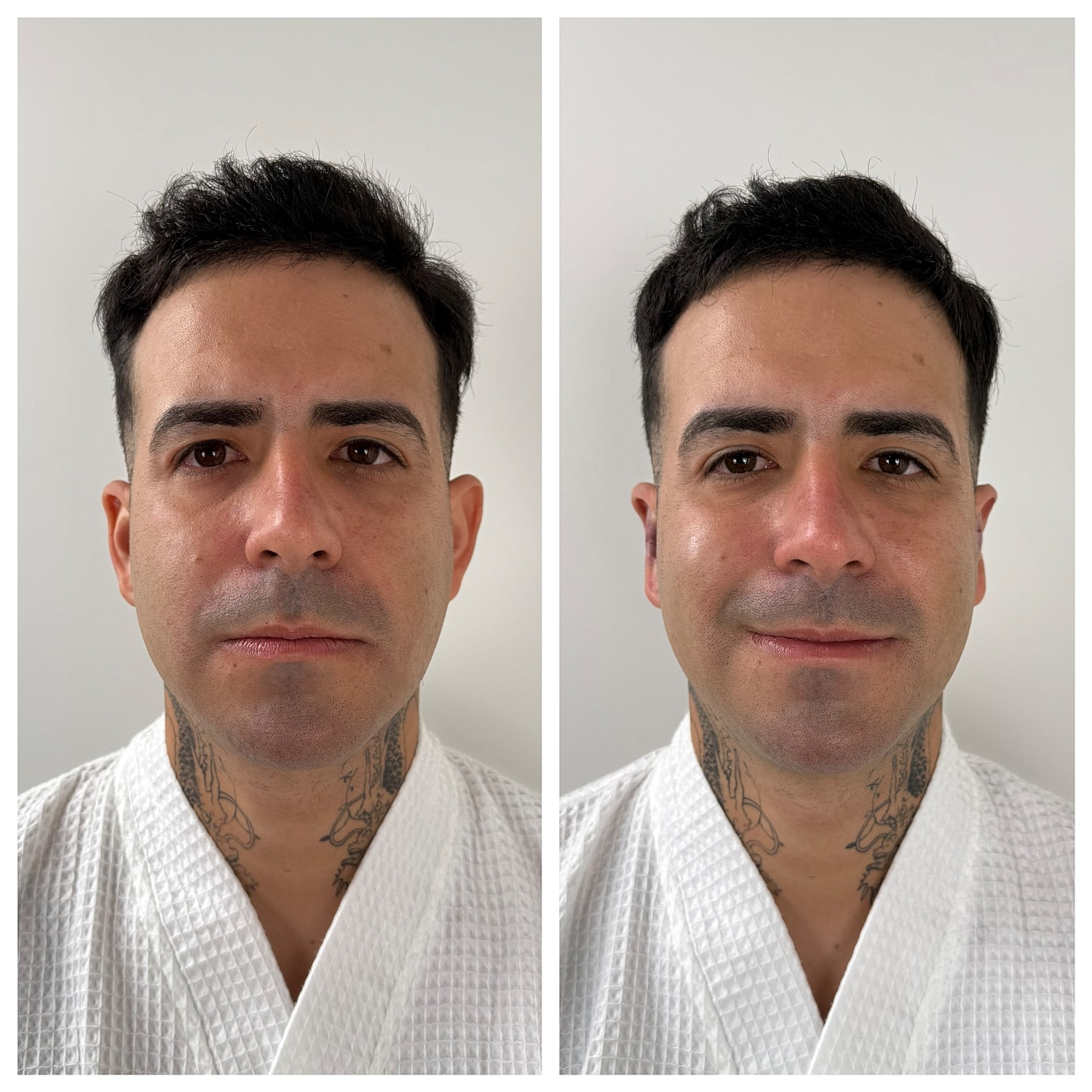 Ear Reshaping Before & After