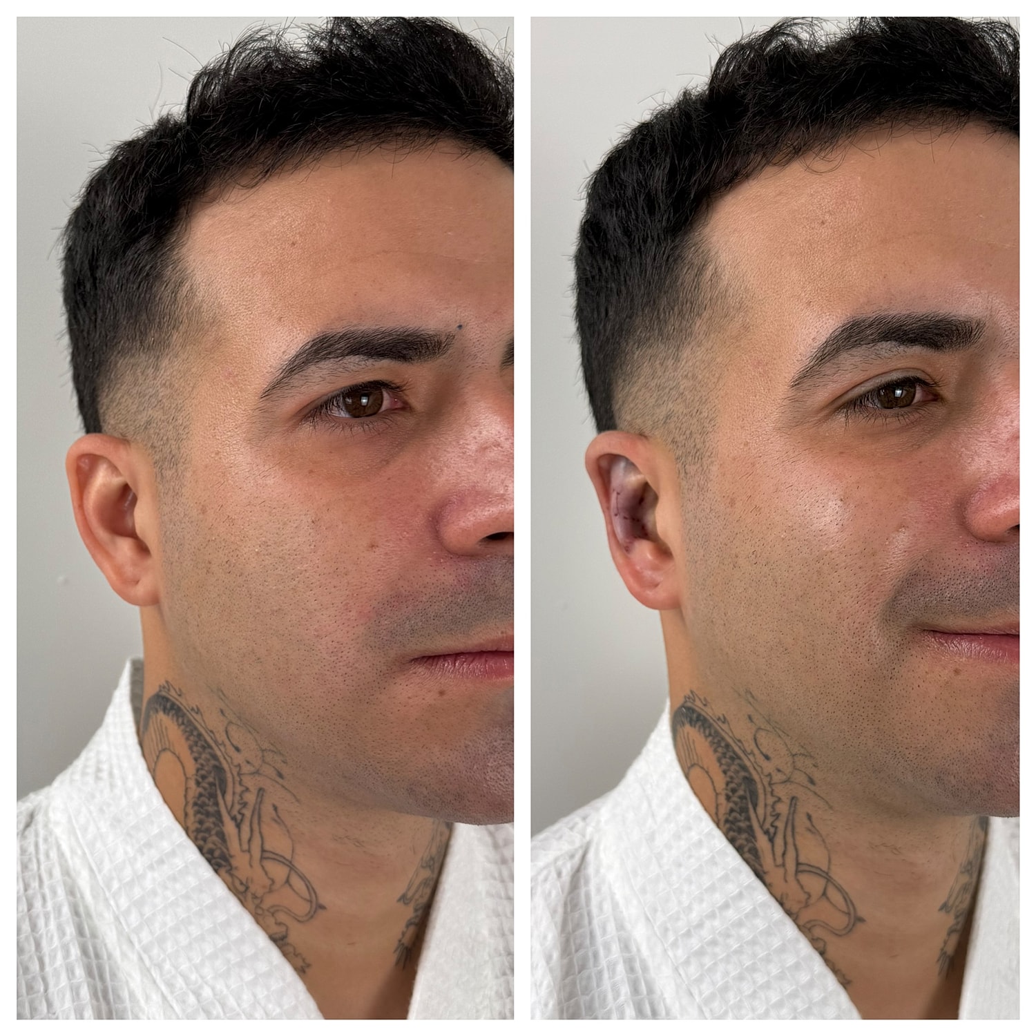 Ear Reshaping Before & After