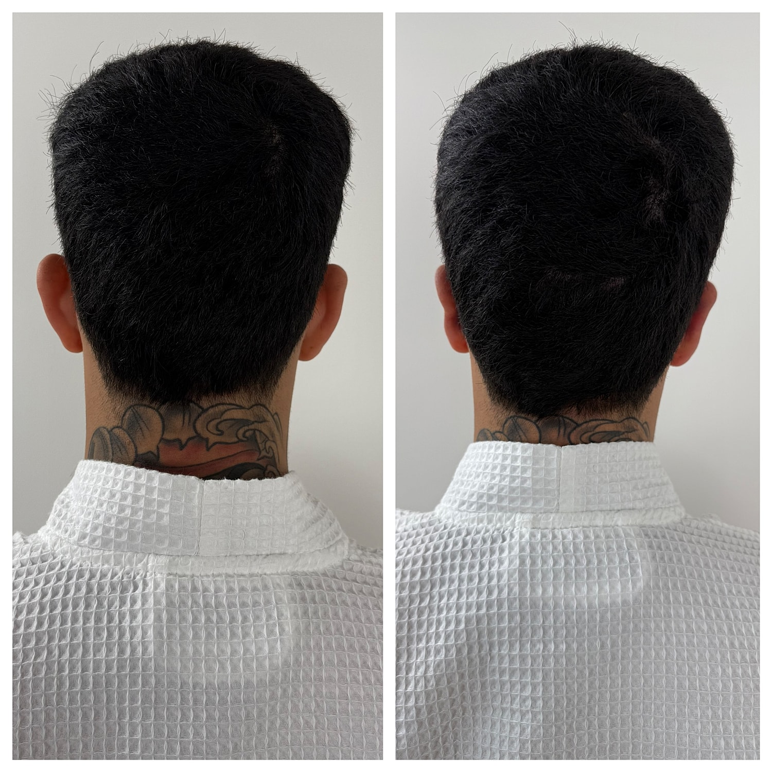 Ear Reshaping Before & After