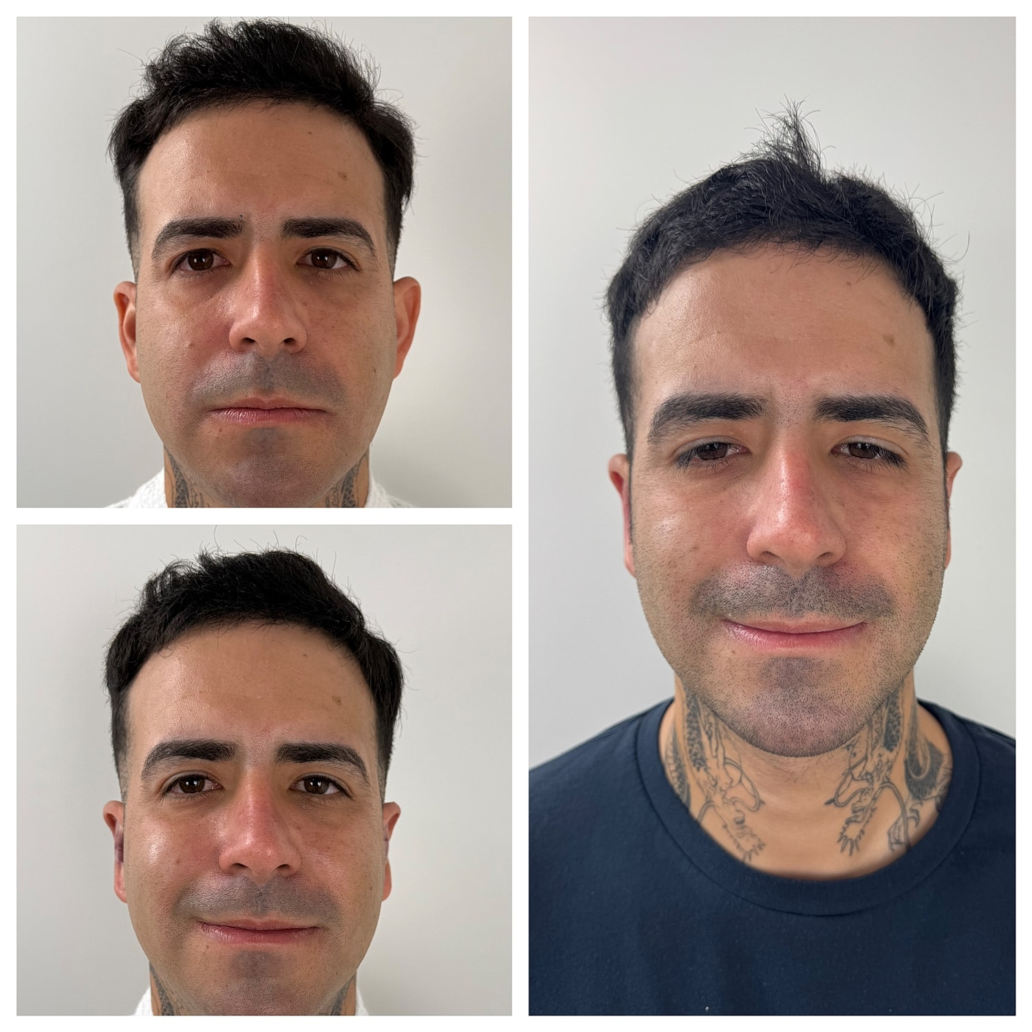Ear Reshaping Before & After