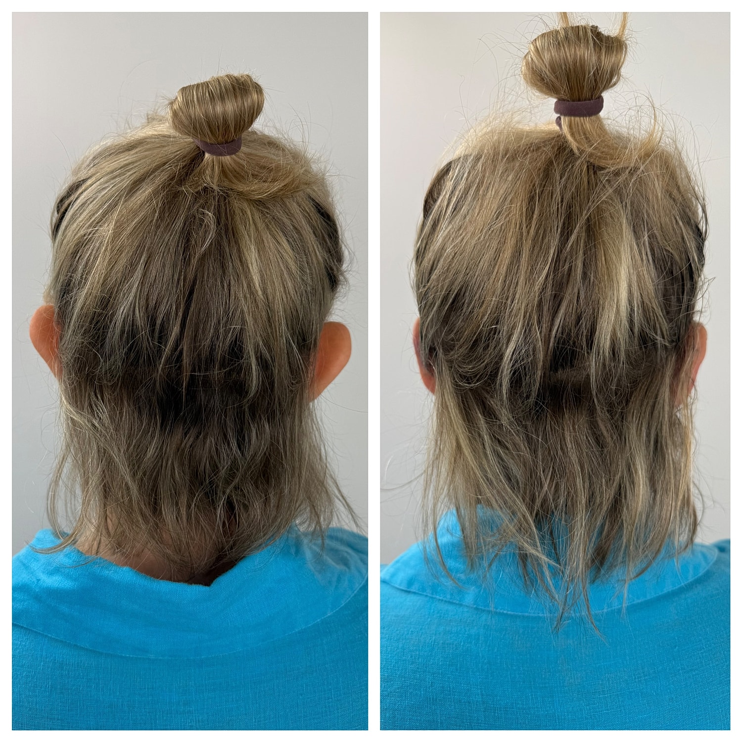 Ear Reshaping Before & After