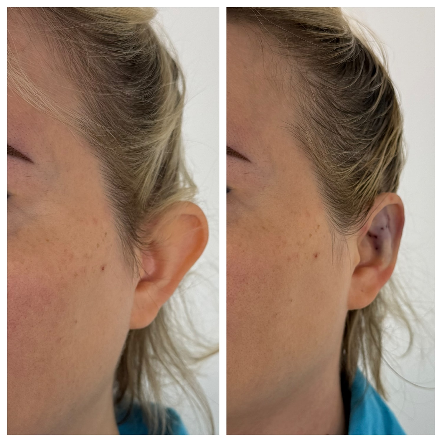 Ear Reshaping Before & After