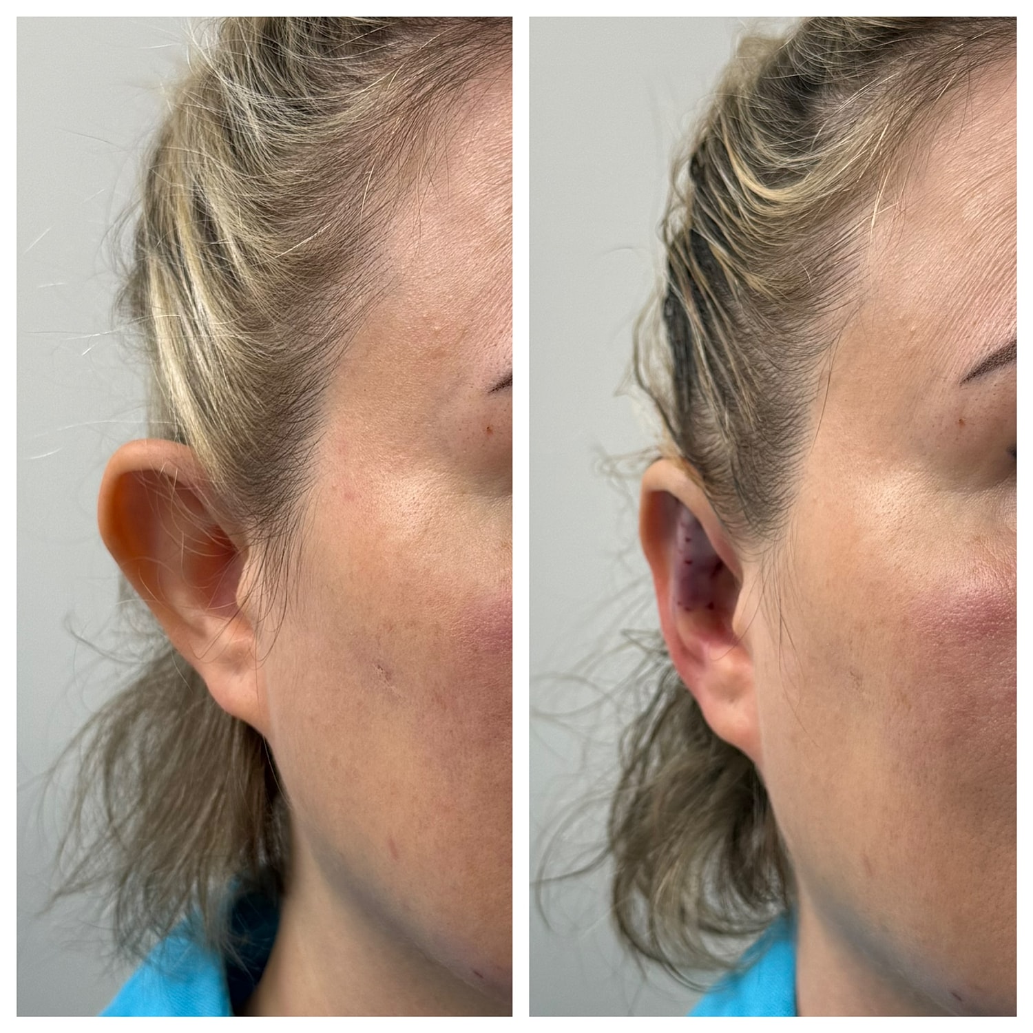 Ear Reshaping Before & After