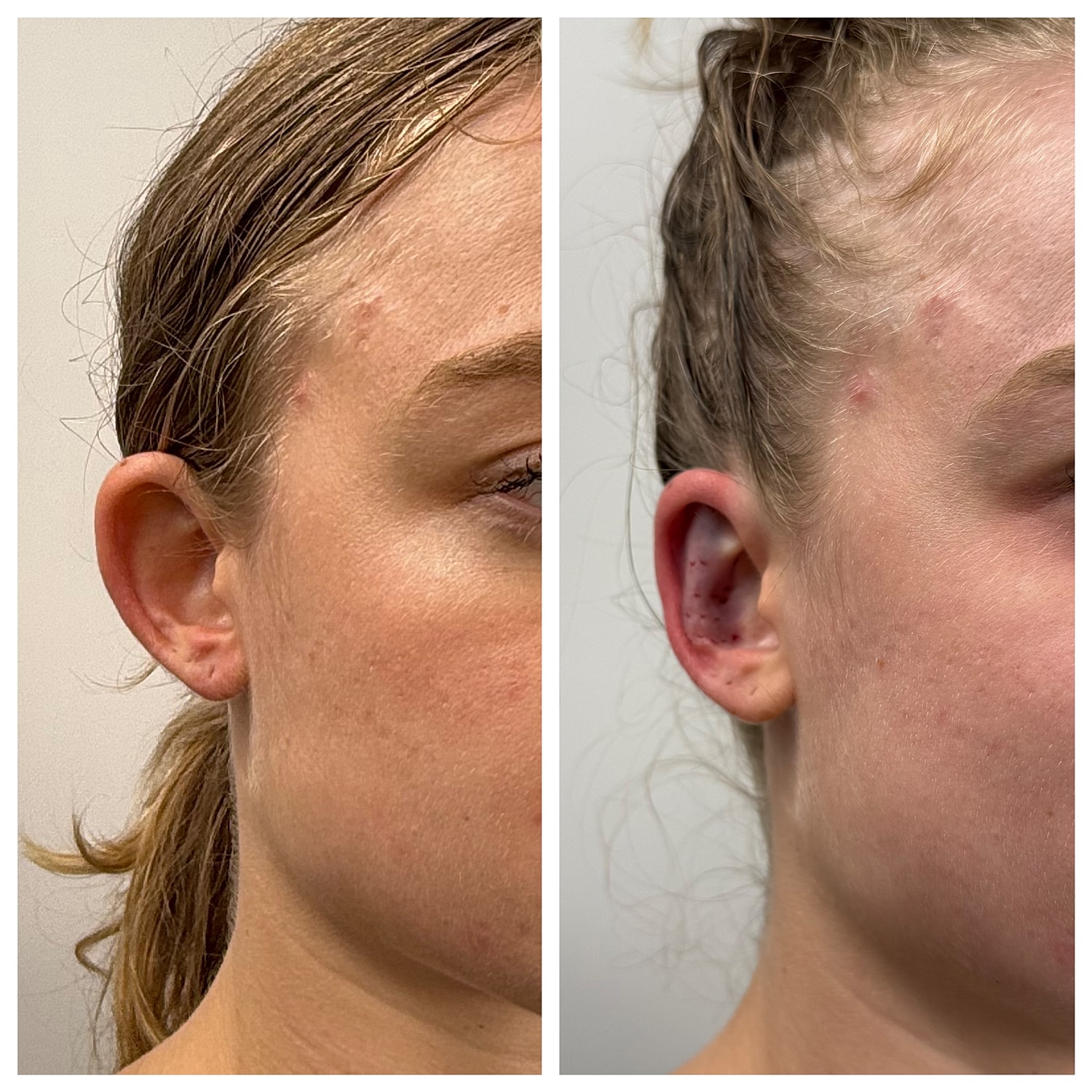 Ear Reshaping Before & After