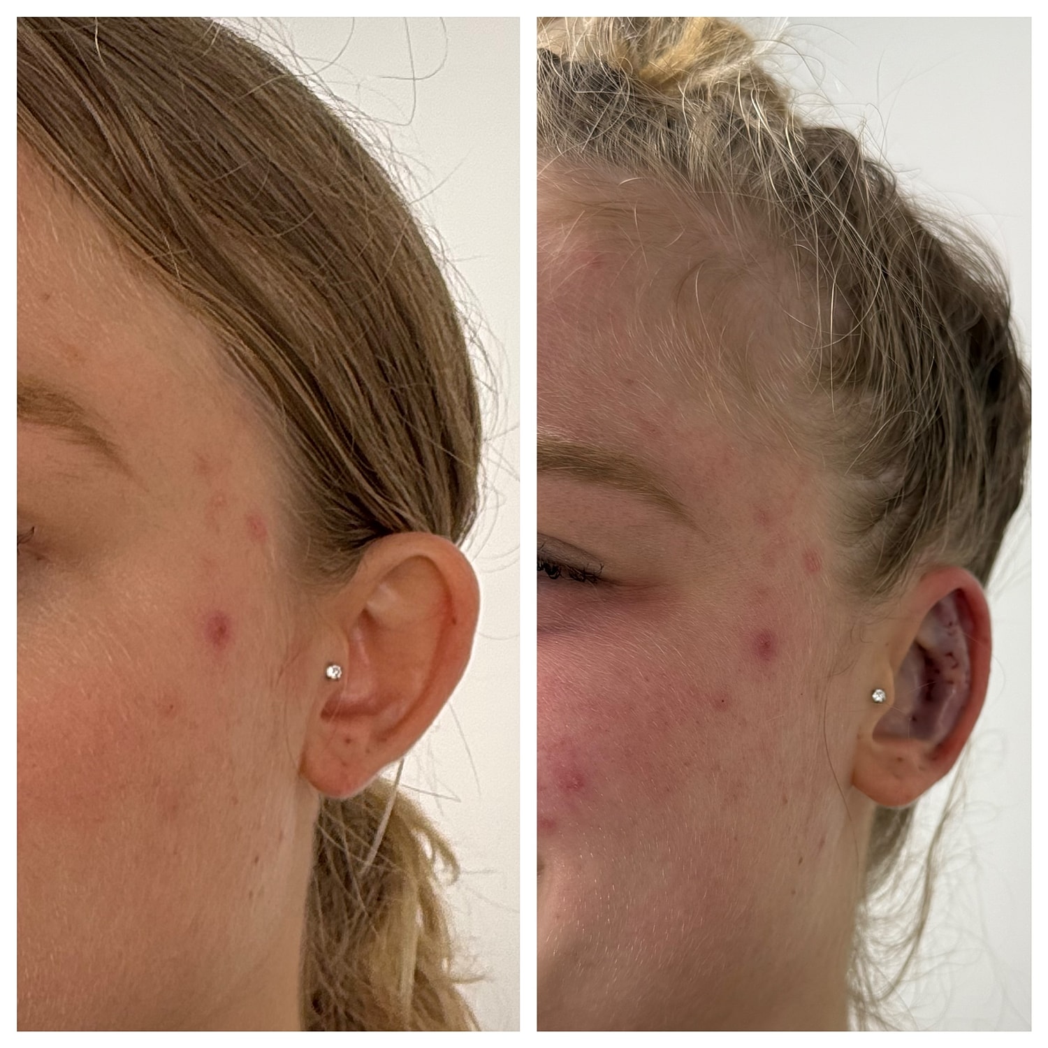 Ear Reshaping Before & After
