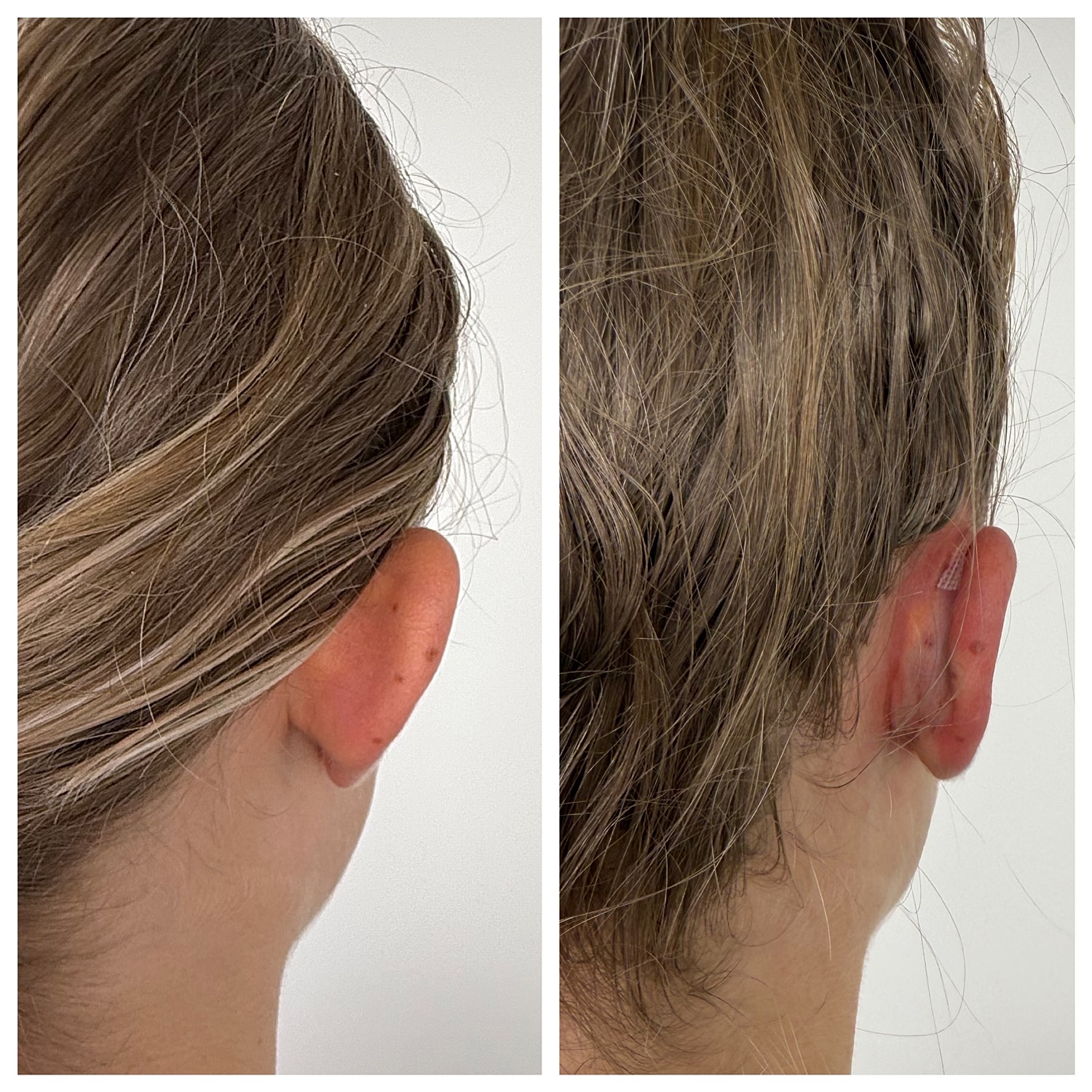 Ear Reshaping Before & After