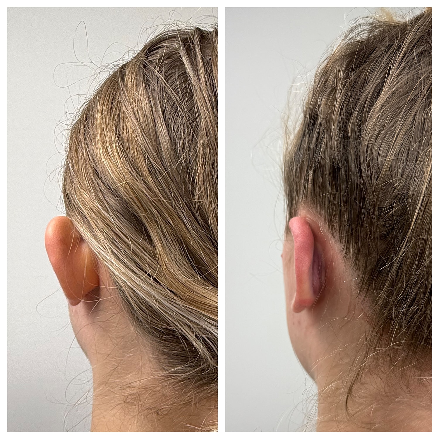 Ear Reshaping Before & After