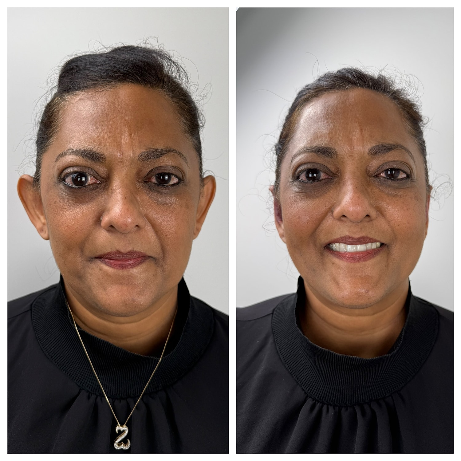 Ear Reshaping Before & After