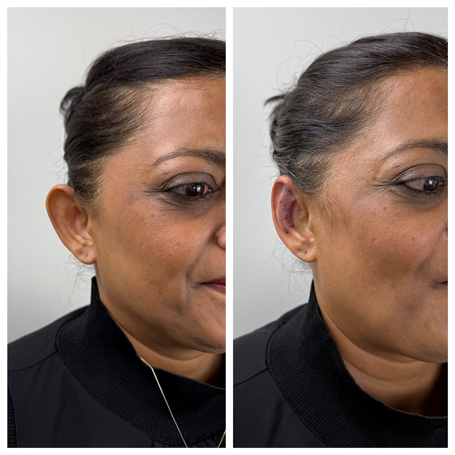 Ear Reshaping Before & After