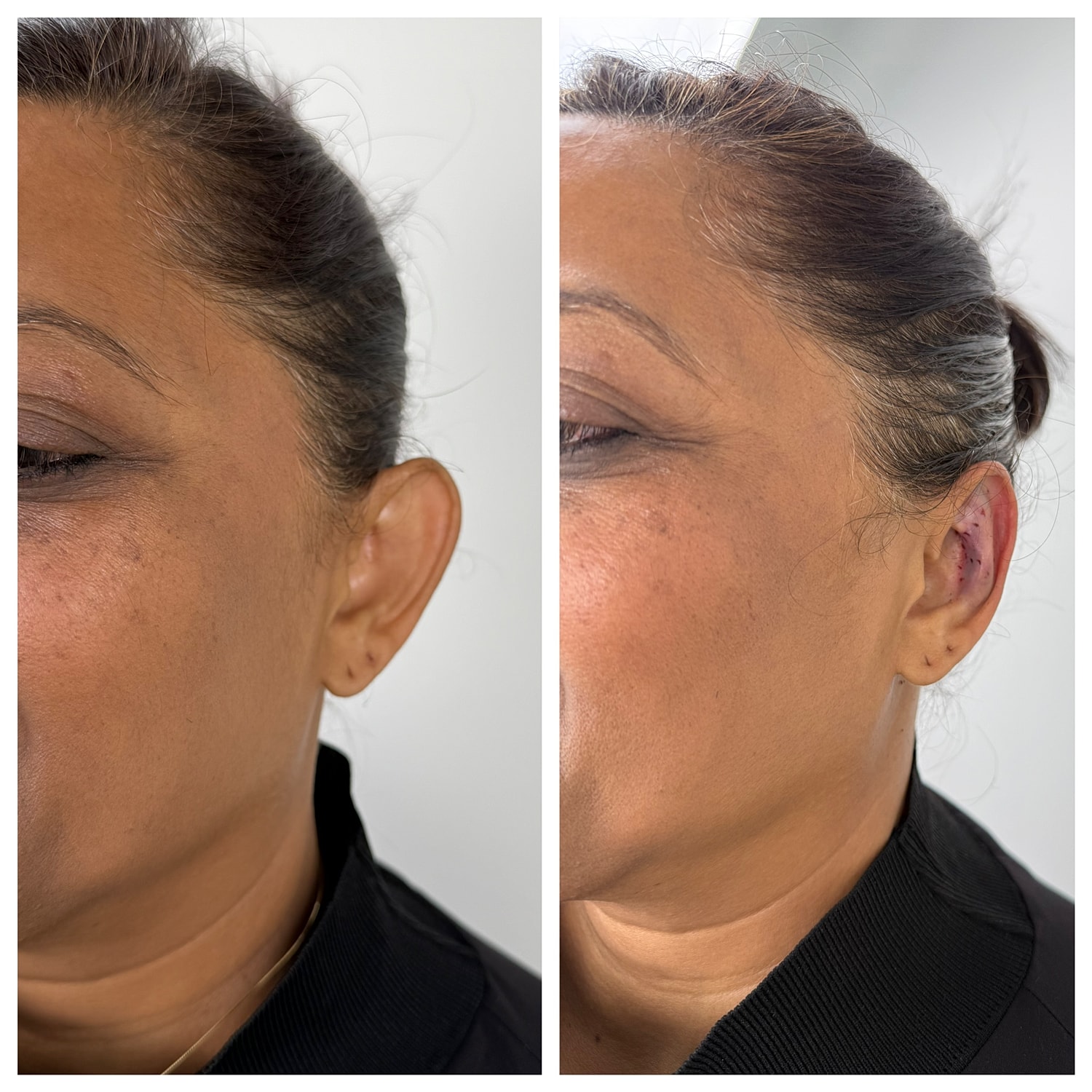 Ear Reshaping Before & After