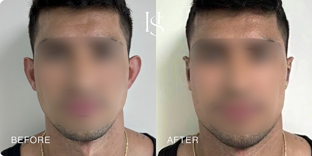 Transformation before and after facial treatment.