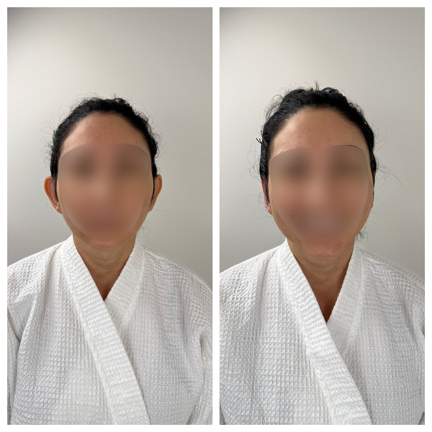 Ear Reshaping Before & After