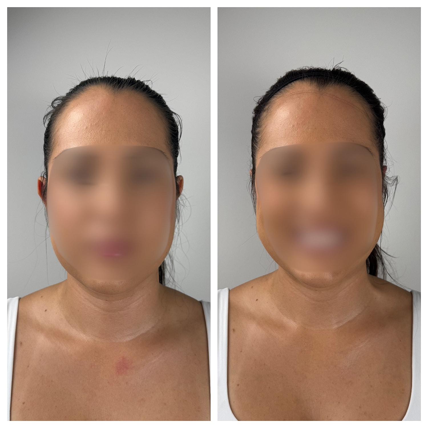 Ear Reshaping Before & After