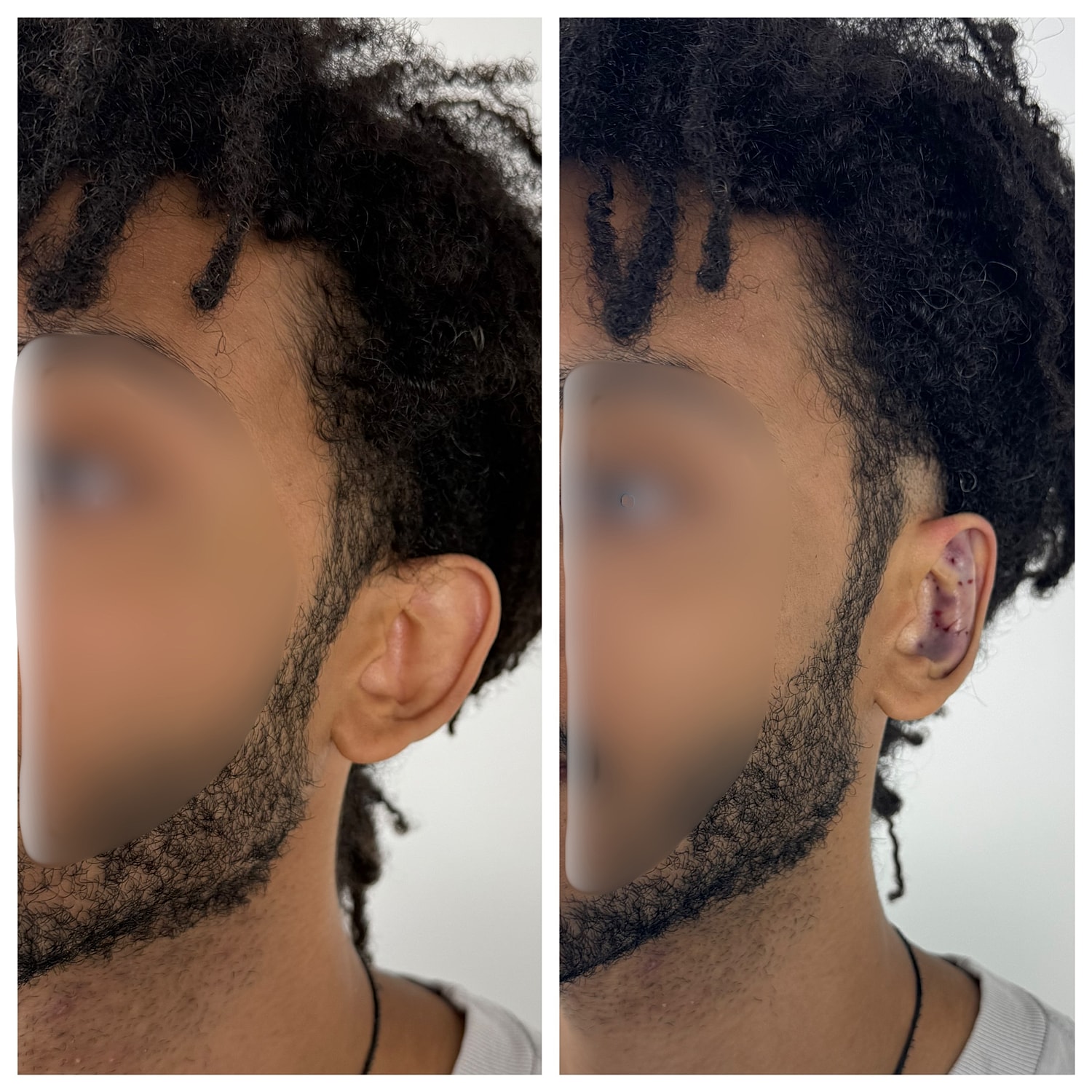 Ear Reshaping Before & After