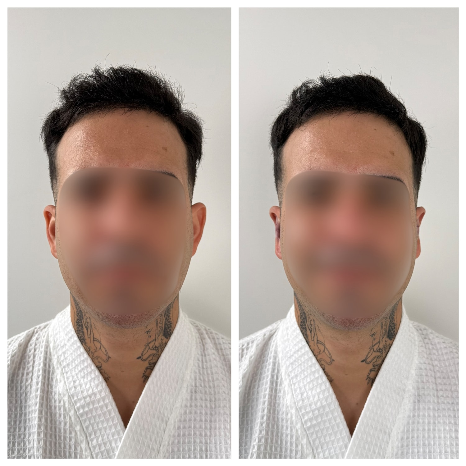Ear Reshaping Before & After