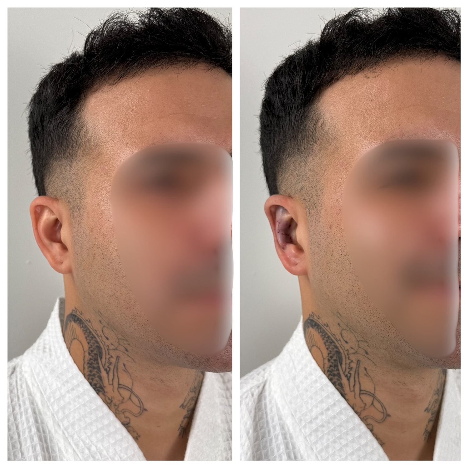 Ear Reshaping Before & After