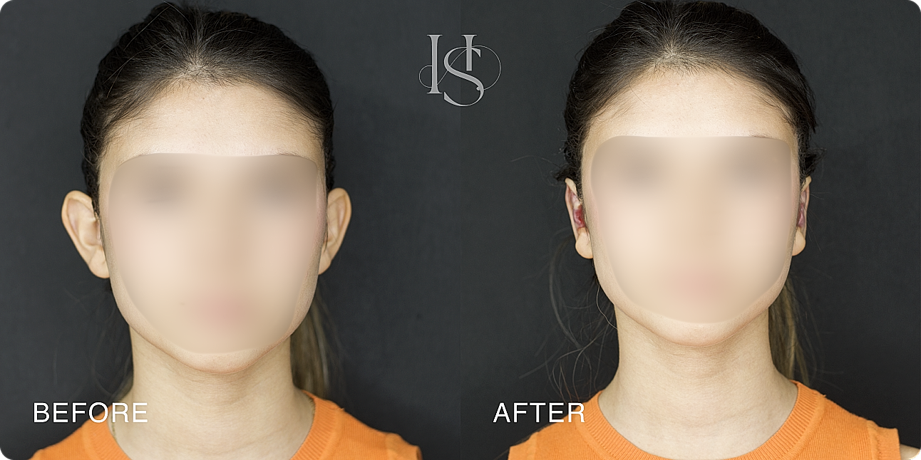 Before and after photo of facial transformation.