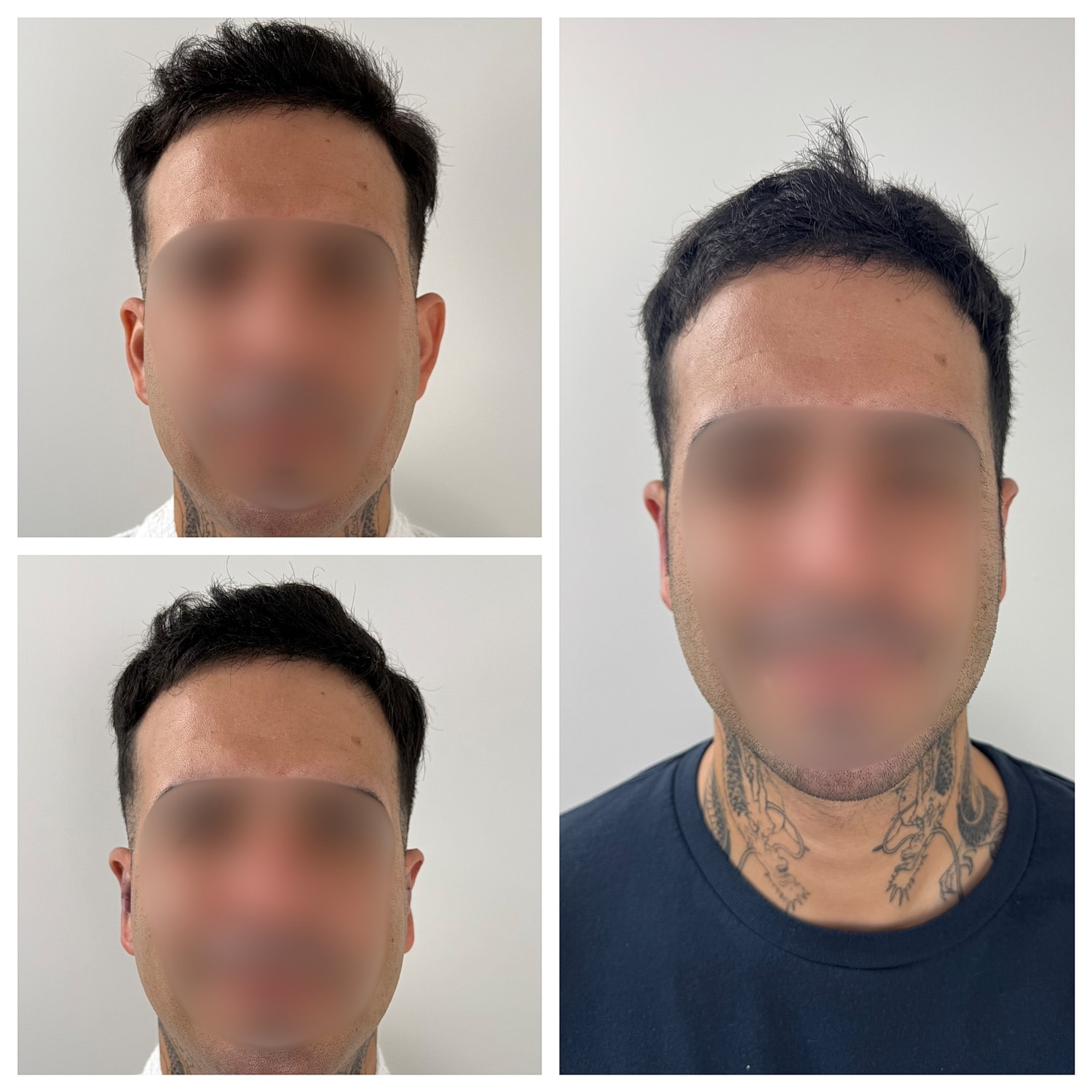 Ear Reshaping Before & After