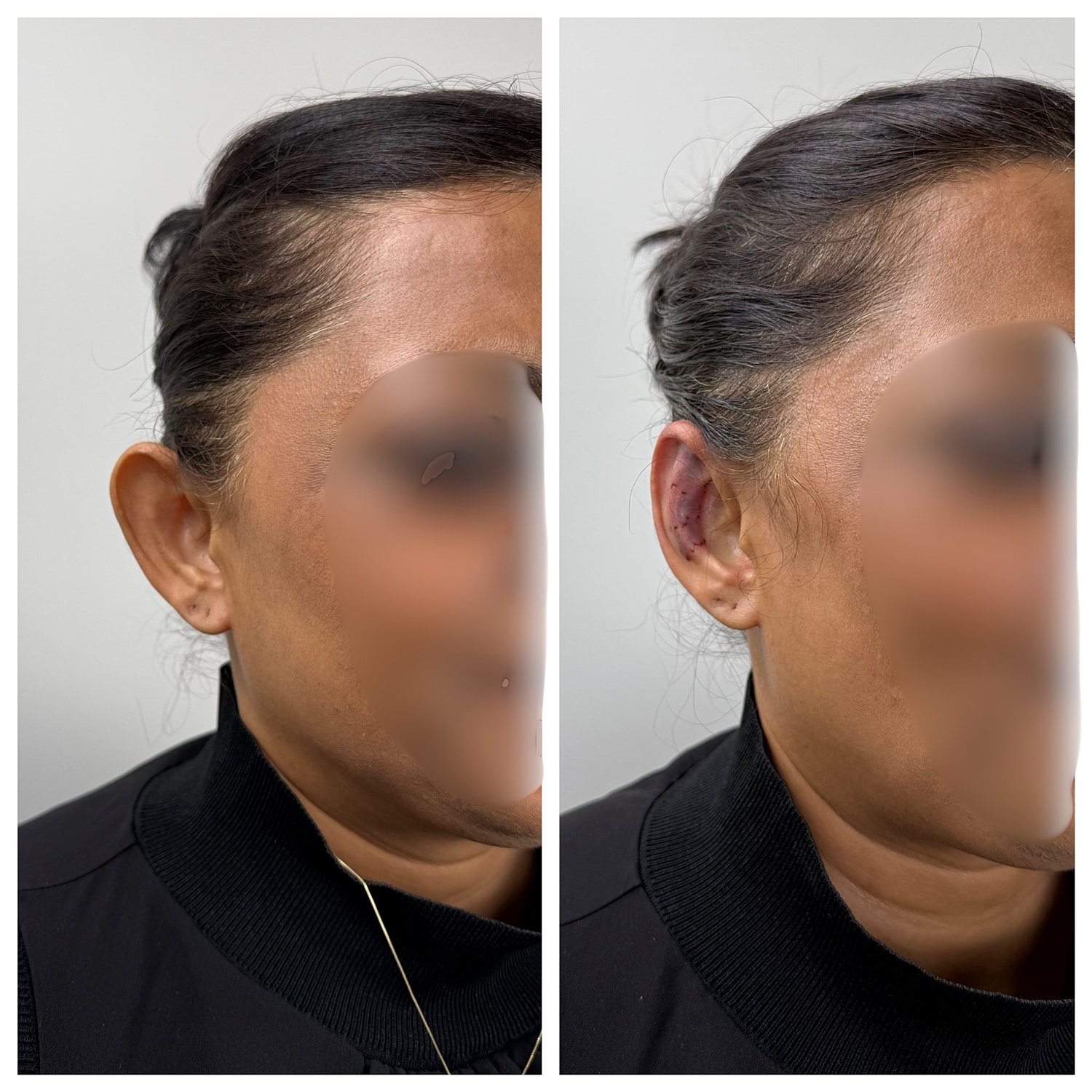 Ear Reshaping Before & After