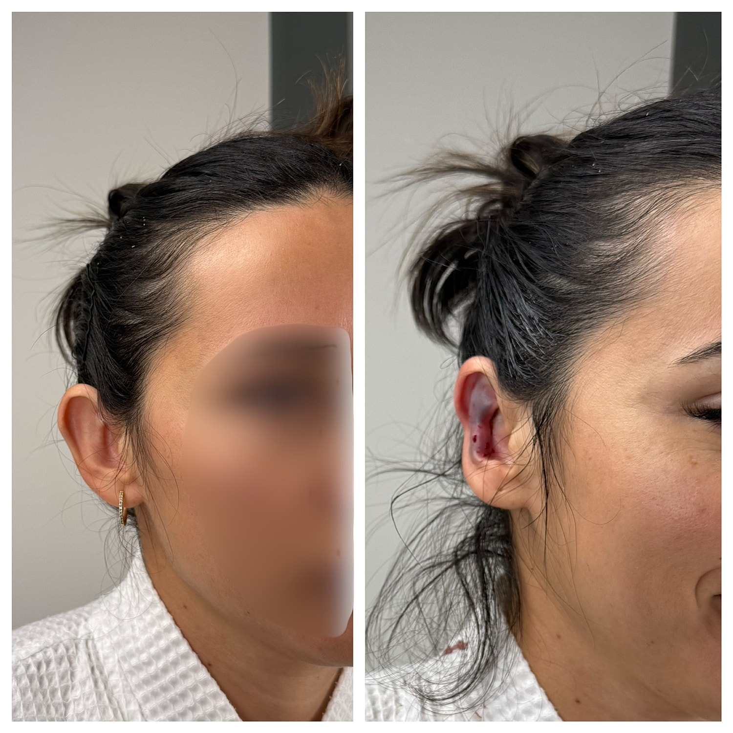 Ear Reshaping Before & After