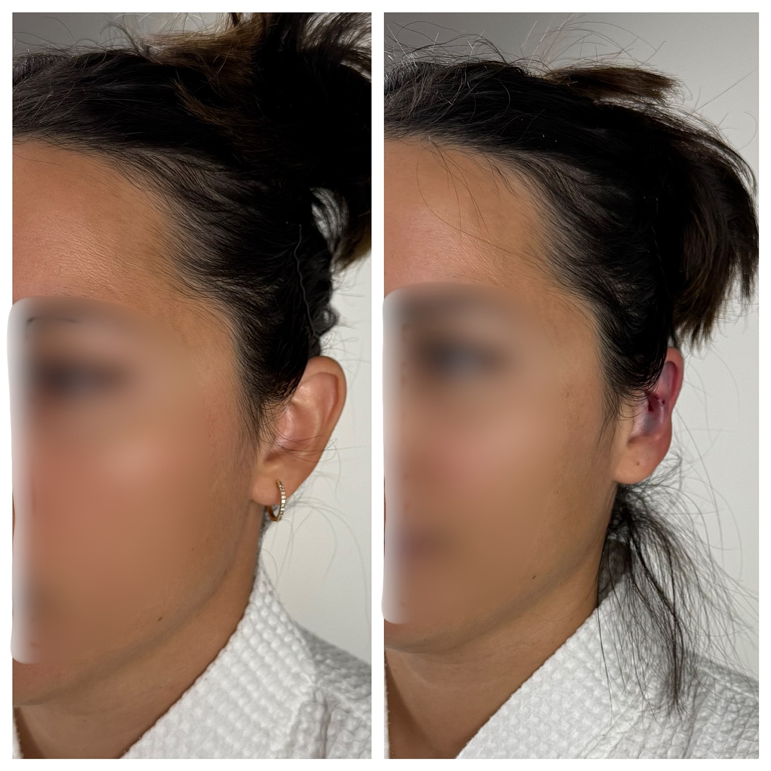 Ear Reshaping Before & After