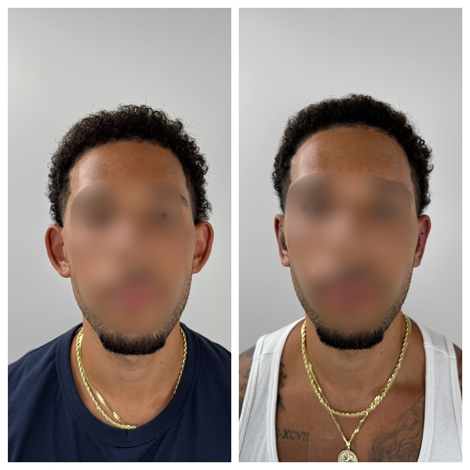 Ear Reshaping Before & After
