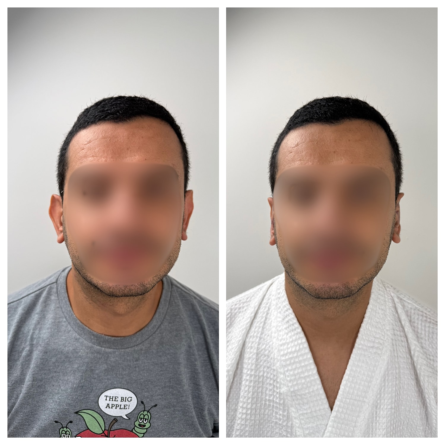 Ear Reshaping Before & After