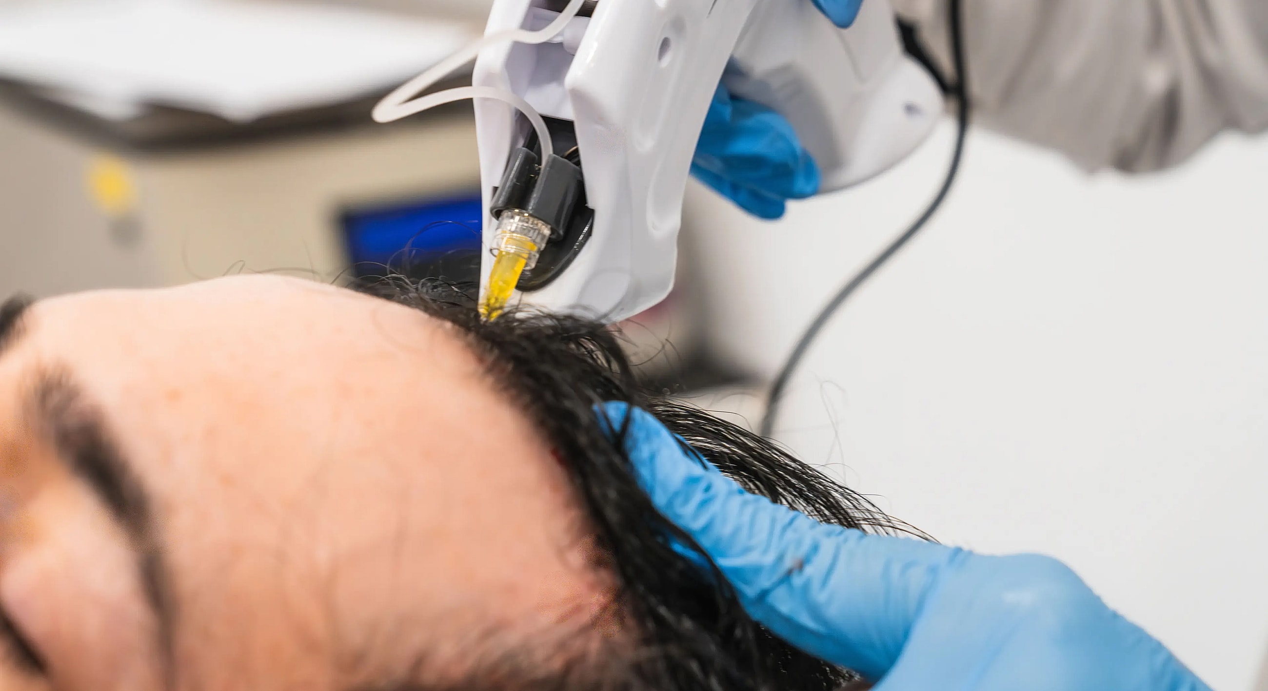 Scalp treatment using a medical device.